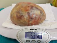 Samsun’da Bir Hastadan Tam 5 Kilo 350 Gram Kist Çıkarıldı