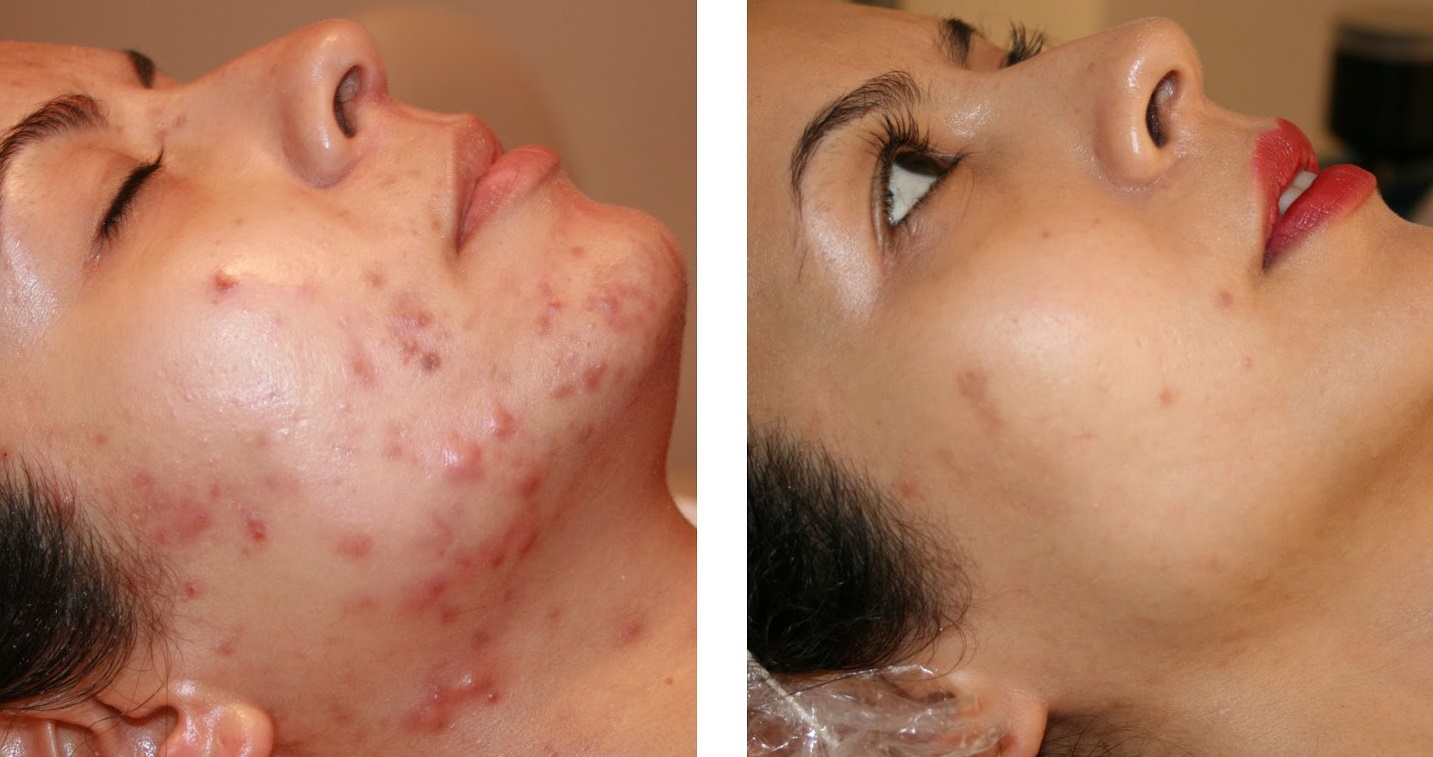 Sırt sivilceleri için maske tarifi Sırt sivilceleri için maske tarifi