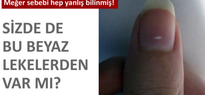 Tırnaklarınızdaki hastalık belirtilerine dikkat edin