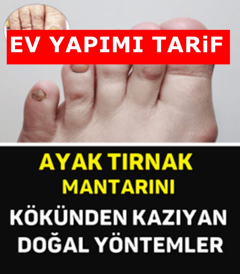 Ayak mantarı ! İşte Kurtaran bitkisel yöntem