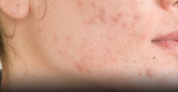 Yüzdeki inatçı sivilce izlerine en etkili çözümle tanışın