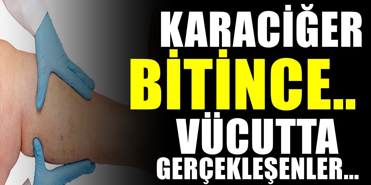 Karaciğer ihmale gelmez. Aylar önceden belli ediyor. Karaciğer hastalığının 5 ciddi belirtisi