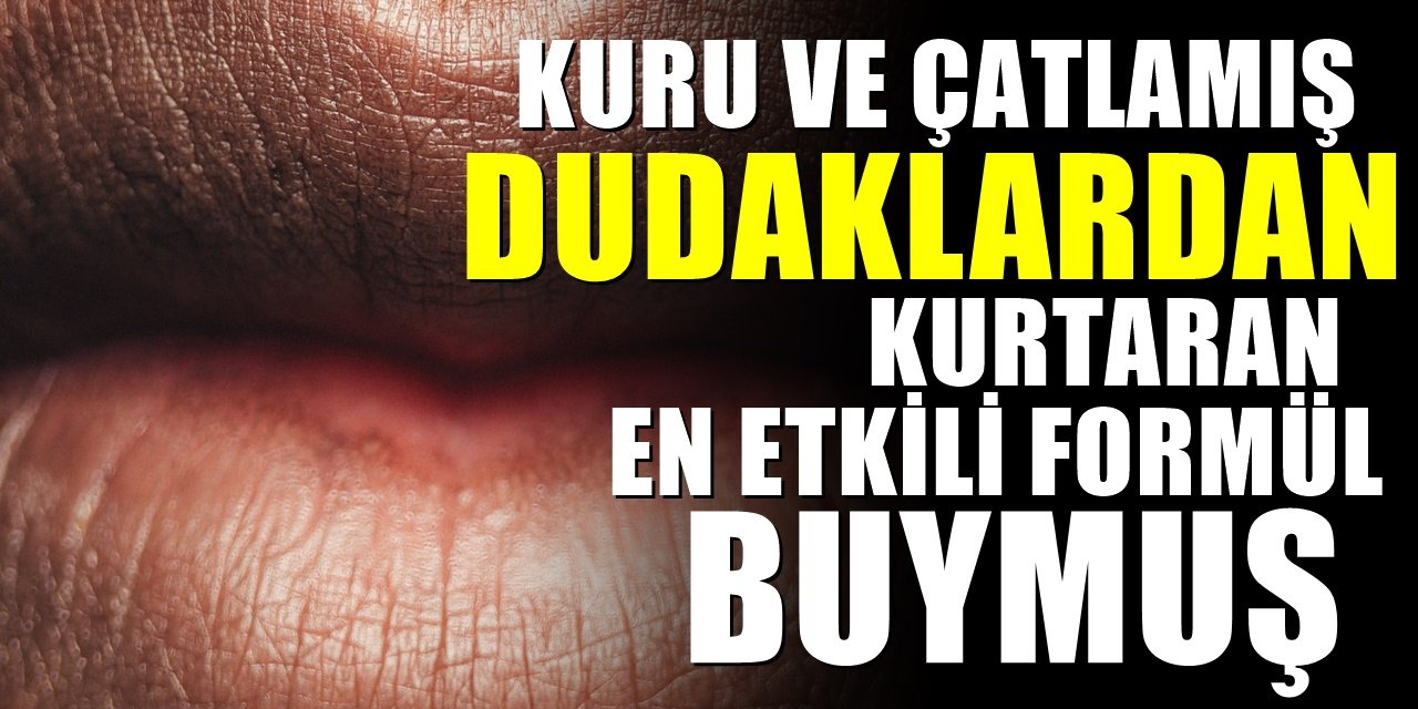 Kuru Dudaklar İçin Neler Yapılmalı? İşte kuru ve çatlamış dudakları geçiren tarif... Mutlaka deneyin