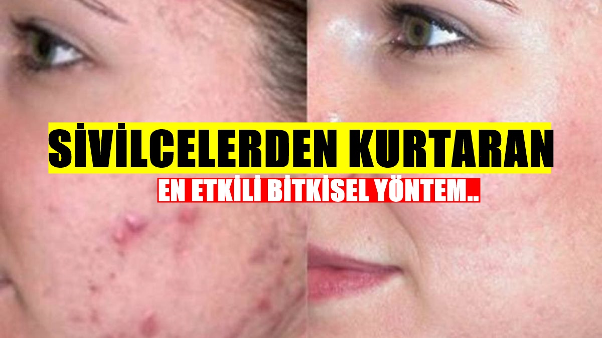 Üç adımda Yüzdeki Sivilcelerden Kurtulmanın En Kolay ve Sağlıklı Yolu! Bir Tutam Karbonat Tarçın Ve...