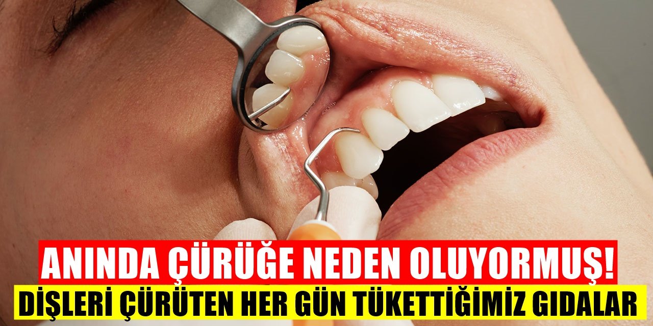 Dişlere Zarar Veren Besin! Seve Seve Tüketiyoruz Oysa Dişleri Çürütüyor
