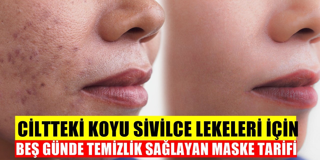 Ciltteki Koyu Lekeleri Beş Günde Geçiren Maske Tarifi! koyu Sivilce Lekeleriniz Varsa...