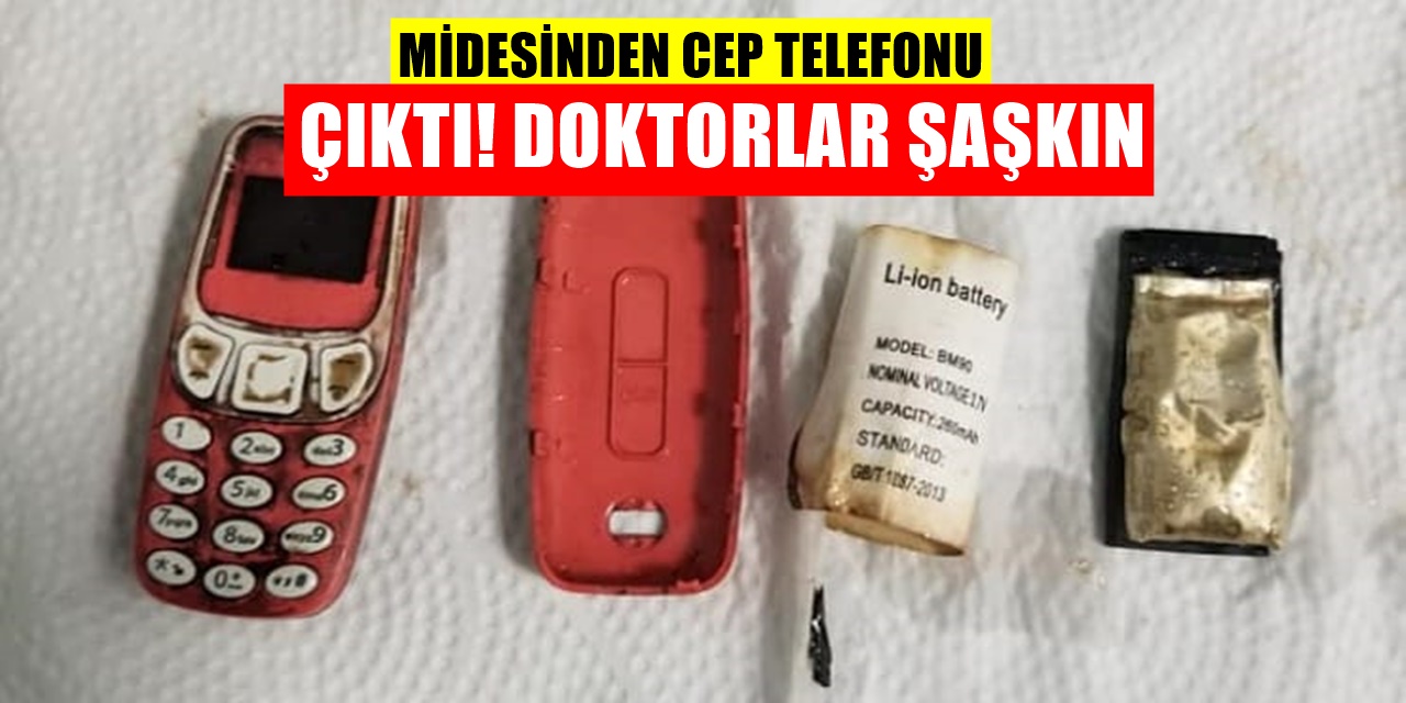 Hastanın Midesinden Nokia 3310 model cep telefonu çıktı, Doktorlar bile şaşkın