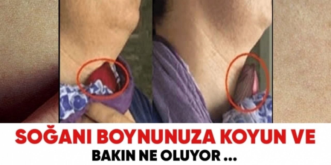 Evet Soğanı Soyup Boynunuza bağlarsanız o sorun geçer
