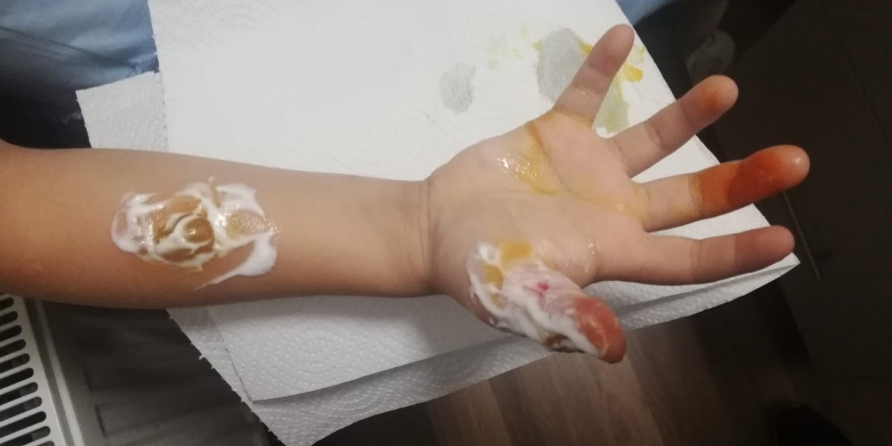 Kadıköy’de Hastanede Mr Çekilen Küçük Kızın Parmakları Ve Kolu Yandı