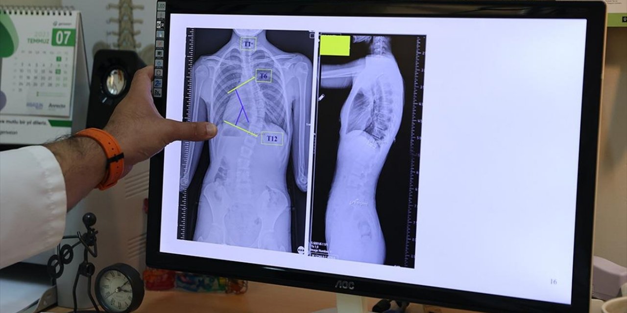 Çocuklarda Ergenlik Öncesi Skolyoz Kontrolü Tedavi Şansını Artırıyor
