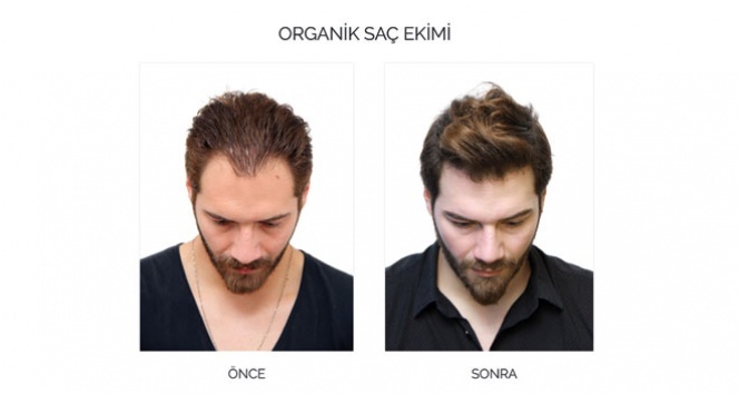 Depresyondaki saçlara organik çözüm