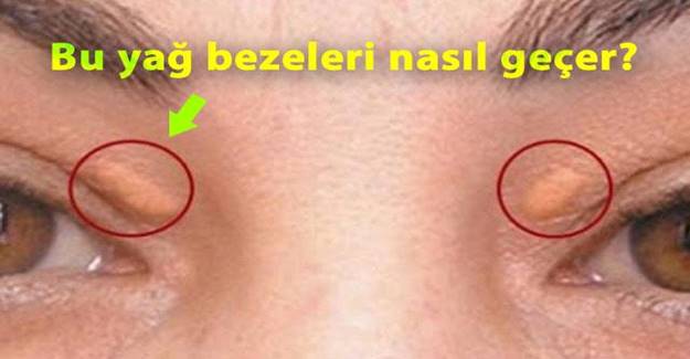 Harika Bir Güzellik Sırrı Göz çevrenizde yağ bezesi varsa bundan uygulayın geçiyor