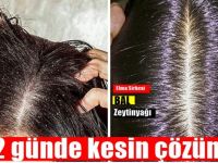Kaşıntılı saç derisinden kurtulmak isityorsanız, işte bilmeniz gerekenler