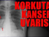 Bir tek Akciğer röntgeni bile kansere neden olabilir