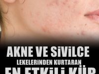Yüzdeki sivilce izleri, lekelerini yok eden yöntem