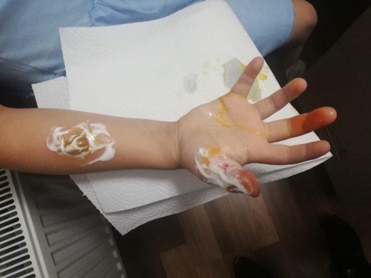 Kadıköy’de Hastanede Mr Çekilen Küçük Kızın Parmakları Ve Kolu Yandı